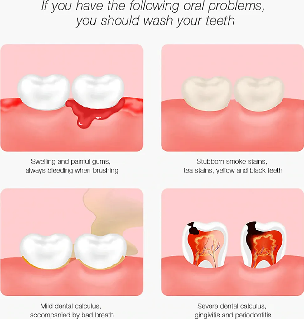 DR.BEI YC2 Ultraschall-Scaler IPX7 Wasserdichter Zahnsteinentferner Mit 3 Modi / LED-Zusatzscheinwerfer Tragbarer Wiederaufladbarer Zahnstein-Zahnsteinschaber Elektrischer Plaque-Entferner Zahnflecken-Reinigungswerkzeug Fuer Erwachsene 5 DR.BEI YC2 Ultraschall-Scaler IPX7 Wasserdichter Zahnsteinentferner Mit 3 Modi / LED-Zusatzscheinwerfer Tragbarer Wiederaufladbarer Zahnstein-Zahnsteinschaber Elektrischer Plaque-Entferner Zahnflecken-Reinigungswerkzeug Fuer Erwachsene – Bild 3
